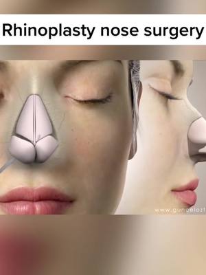 A post by @interestinggggggggggggg on TikTok caption: Rhinoplasty nose surgery Credits: Güncel Öztürk #nosesurgery #surgery #nose #rhinoplasty #fy #fyp #xyzbca