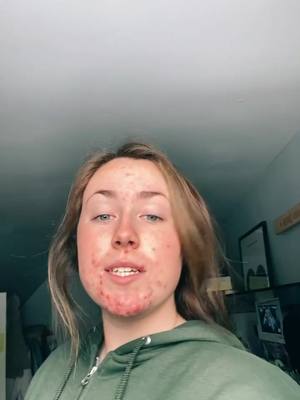 A post by @lizzyjohnstone on TikTok caption: Best thing I ever did #accutane