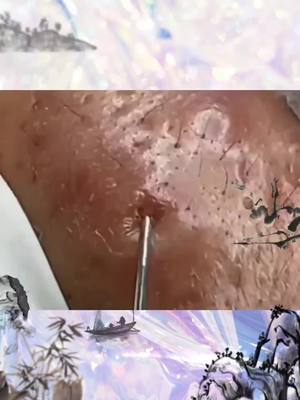 A post by @zhoushengbo on TikTok caption: 🤩🤩🤦‍♂️#foryou #foryoupage #Gospelcom #zit #acnehelp #mites #blackhead #acneremoval #acne #fypシ #cleanup #removal #asmr #acnefighter #fyp