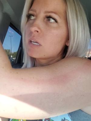 A post by @undeniably_sam on TikTok caption: lesson learned #burned #sunscreen #nope #over30 #yaliveyalearn