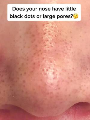 A post by @beautyangle46 on TikTok caption: 👌👌👌#foryou #blackheads