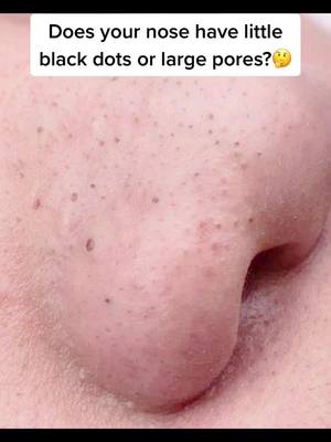 A post by @beautyangle46 on TikTok caption: #foryou #blackheads #blackheadsremoval#fypシ