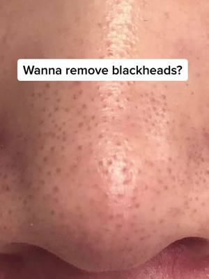 A post by @beautyangle46 on TikTok caption: #foryou #blackheads #blackheadsremoval #skincare #fypシ