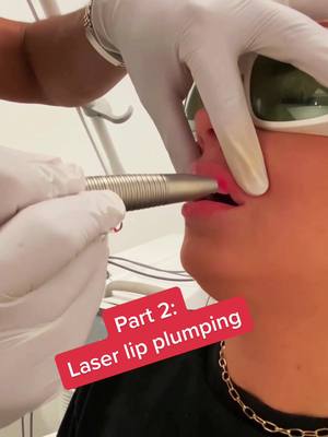 A post by @nalluriplasticsurgery on TikTok caption: Laser lip plumping PART 2 #plasticsurgeon #plasticsurgery #foryou #foryoupage #fyp #doctor #beauty #surgery