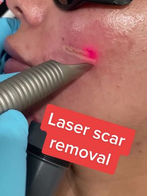 A post by @nalluriplasticsurgery on TikTok caption: Laser scar removal! Leave us any questions you have about the treatment! #plasticsurgeon #plasticsurgery #fyp #foryou #foryoupage #doctorsoftiktok #doctor #skin #laser