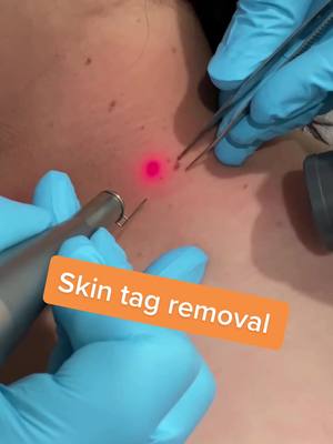 A post by @nalluriplasticsurgery on TikTok caption: Watch us remove a skin tag with a laser! #plasticsurgeon #plasticsurgery #fyp #foryou #foryoupage #surgery #doctor