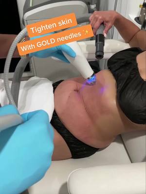 A post by @nalluriplasticsurgery on TikTok caption: Tighten your skin with ✨GOLD✨ needles! #plasticsurgeon #plasticsurgery #doctor #fyp #foryou #foryoupage #doctorsoftiktok #laser