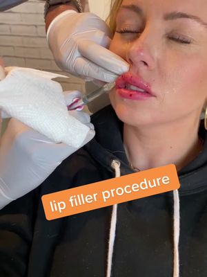 A post by @nalluriplasticsurgery on TikTok caption: Watch how lip filler is injected! #lipfiller #lip #plasticsurgery #plasticsurgeon #doctor #fyp #foryou #foryoupage