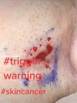 A post by @michellerae1972 on TikTok caption: #skincancerawareness #cancersurvivor