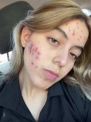 A post by @reginaagglzz on TikTok caption: Fuck you accutane😁😁😁😁