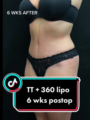 A post by @theplasticsurgerygroup on TikTok caption: Her progress has been INSANE. Tall, stunning beauty 6 wks after tummy tuck and 360 lipo.  Gonna be unreal in a few months! #tummytuck #cincinnati #ohio #kentucky #plasticsurgery