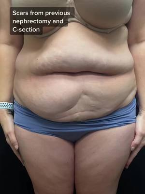 A post by @theplasticsurgerygroup on TikTok caption: 6 wks after lipoabdominoplasty. Her granddaughter said “Nanna, now you have a belly button too!”💕 #tummytucksurgery #liposuction #tummytuckscars #surgery