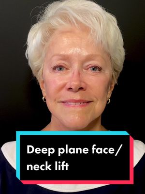 A post by @theplasticsurgerygroup on TikTok caption: A “deep plane” technique works on the underlying muscles, deep connective tissue and retaining ligaments in the face to achieve a more thorough lift with a very natural looking appearance. #facelifting #necklifting #plasticsurgeon #deepplanenecklift #fatgrafting