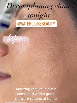 A post by @laurasdermaclinic on TikTok caption: Amazing results after dermaplaning for my beautiful client, combined with a consistent skincare routine at home. Used #jaderollers in clinic with hyaluronic mask and client will use it home as well for her night routine when applying the moisturiser and anti-ageing cream. #dermaplaning #dermaplaningdeluxe #dermaplaningfacial #express #skinrejuvenation #skinregeneration #relaxation #jaderollers #skincareroutine #finelines #smallerpores #betterskincarebettermakeup #skinexfoliation #cleansing #toning #desinfecting #moisturising #dermaplaning #instantpainlesspeel #toning #lip&eye