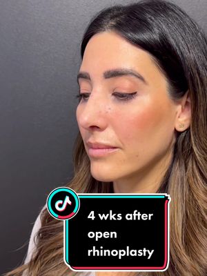 A post by @theplasticsurgerygroup on TikTok caption: Beautiful to start. 4 wks after open rhinoplasty. The blooper at the end is the best part 🥰 #ohio #kentucky #rhinoplasty #plasticsurgery