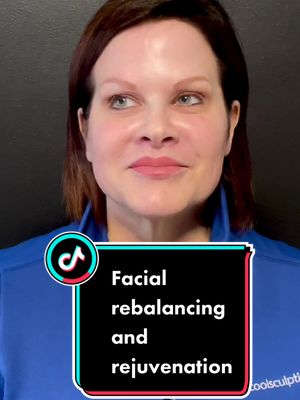 A post by @theplasticsurgerygroup on TikTok caption: Facial rebalancing and rejuvenation using a combination of surgical and nonsurgical treatments. All procedures were performed in office without need for sedation. #plasticsurgery #upperliplift #nonsurgicalfacelift #cincinnati