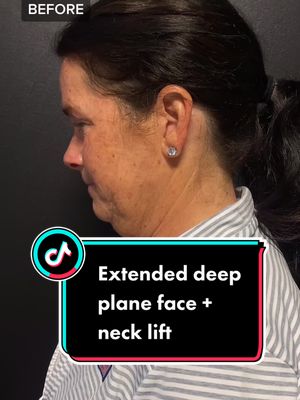 A post by @theplasticsurgerygroup on TikTok caption: Early in healing process but you can already see the difference, especially with the neck and jawline. Next phase will be CO2 fractionated laser skin resurfacing to address the sun damaged skin tone and texture, upper eyelid/brow lift, and lip lift. Stay tuned! #facelifting #necklifting #ohio #kentucky #cosmeticsurgery 