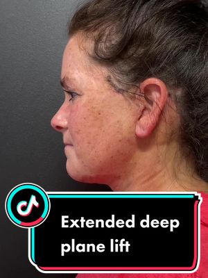 A post by @theplasticsurgerygroup on TikTok caption: 3 wks after extended deep plane facelift, necklift, and buccal fat removal. #facelift #necklift #facialplasticsurgery #plasticsurgery 