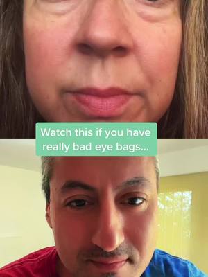 A post by @holistic.healing.usa on TikTok caption: #duet with @chattygirl72 how to get rid of under eye bags using a cream hack!