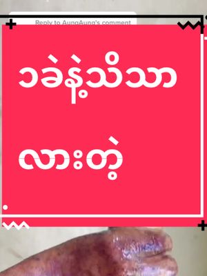 A post by @thirihanaung2 on TikTok caption: Replying to @AungAung #ဖြေပေးလိုက်ပြီနော် #အသားမဲတွေလာကြနော် #tiktokuni #fypシ #tiktokmarketplace #thinkb4youdo #studytips #skincare #yourmysoap #တွေးပြီးမှတင်ပါ #အသားဖြူချင်သူများအတွက် 