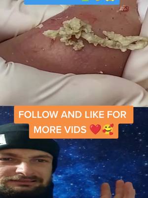 A post by @pushthebutton.ly on TikTok caption: FOLLOW and LIKE for more VIDS ❤️🥰 #reaction #fypシ #fyp #foryou #extractions #satisfying #pimplepopper 