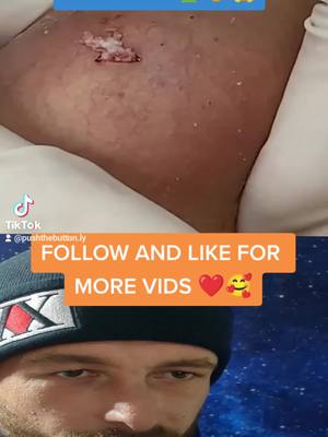 A post by @pushthebutton.ly on TikTok caption: FOLLOW and LIKE for more VIDS 🥰❤️ #pimplepopper #satisfying #extractions #foryou #fypシ #cystpopping 