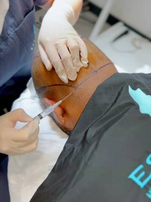 A post by @esterivaclinic on TikTok caption: Hair Transplantation procedure ✍🏻💉 - 3000 grafts implanted ✔️