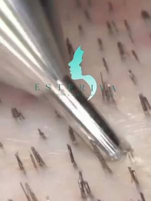 A post by @esterivaclinic on TikTok caption: Extracting some goodies from the donor area 💉 #hairtransplantation #esterivahair #fyp #viral