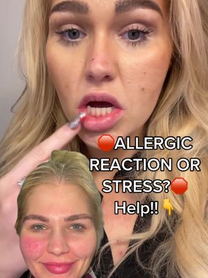 A post by @mclivinit on TikTok caption: IF YOU KNOW WHAT THIS IS… PLEASE SHARE YOUR STORIES WITH ME!! #hives #mclivinit #allergicreactions #gastricbypass #mcstory #health #wellness #redness #allergies #stress #stressmanagement  #reaction #medicaltiktok  #postop #rny #bariatricsurgery  #wls #wlscommunity  #Lifestyle #disease #MentalHealth  #physical #wellbeing 