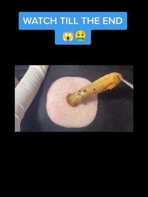 A post by @pushthebutton.ly on TikTok caption: FOLLOW AND LIKE FOR MORE VIDS 🥰🥰 #fakebody #pimplepopper #fyp #foryou #cystpopping #pimple #satisfying #extractions 