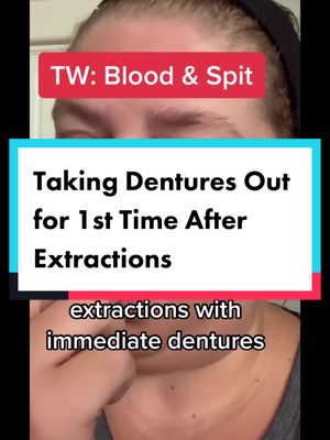 A post by @jen428777 on TikTok caption: 24 hours after extraction and get to take dentures out for the first time! This is for educational purposes! #dentures #immediatedentures #