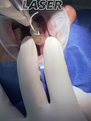 A post by @odontologiatecnologia on TikTok caption: Recorte de encia o gongivectomía #laser #gingivectomy #gingivectomia #laserdental #odontologiatecnologica