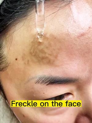 A post by @slimming1616 on TikTok caption: It’s time to get rid of the spots #freckles #spots #makeup #skin 