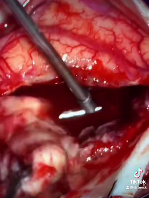 A post by @dr.ben.k on TikTok caption: Have you ever seen a brain abscess before?! The #brain is amazing #doctor #surgery #science #education 