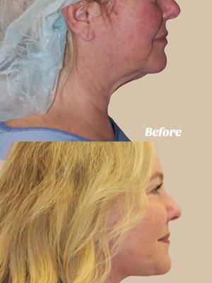 A post by @drmichellelee on TikTok caption: Who said facelifts can’t be both transformative and natural? #facelift #necklift #beforeandafter #fyp #plasticsurgery #fattransfer #faceliftsurgery