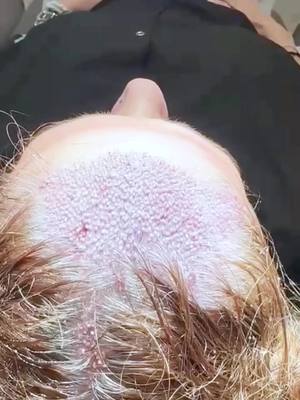 A post by @esterivaclinic on TikTok caption: 1500 grafts implanted  #fyp #hairtransplant #dhi 