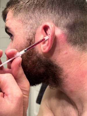 A post by @waterbearops on TikTok caption: Fixing your cauliflower ear the easy way!#brazilianjiujitsu #wrestling #mma #blood #nasty #judo #cauliflowerear 