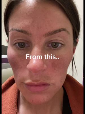 A post by @myfriendscallmeaubs on TikTok caption: #beforeandafter #beforeandafterskincare #skintransformation#beskintransformationagedskin #melasma #skinpen #microneedling #medspa #medicalgradeskincare #chemicalpeel #spf #sunscreen #skincarefor30s