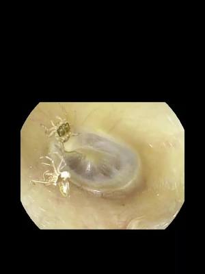 A post by @drbeltrang on TikTok caption: una araña en el oído  #spider #araña #queharias #quéharías #ear #earspider #oído #oido 