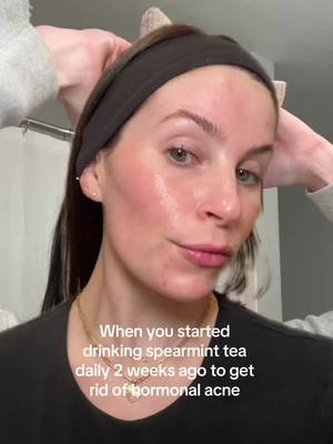 A post by @myfriendscallmeaubs on TikTok caption: #acneskincare #spearmintteaforacne #skincare #greenscreen #naturalremedy