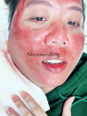 A post by @unusualorganism on TikTok caption: Microneedling #microneedlingtherapy 