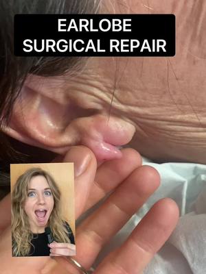 A post by @thatdermlife on TikTok caption: The love looks like a little mitten or lobster claw! #dermatologist #LearnOnTikTok #earloberepair 