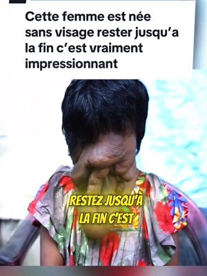 A post by @mikamydofficiel on TikTok caption: Cette femme est née sans visage #histoirevrai #maladie #neurofibromatose 