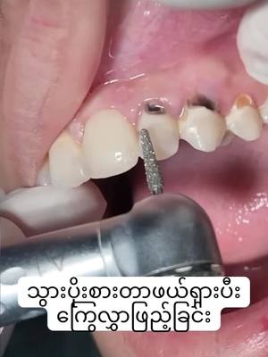 A post by @pearldentalclinic0 on TikTok caption: သွားပိုးစားတာကြွေလွှာဖြည့်လို့ရပါတယ်နော်#ပုလဲသွားဆေးခန်း #သွားဆေးခန်း 