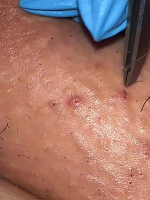 A post by @nakedskinbybrina on TikTok caption: #ingrownremoval #satisfying #skincare #waxing