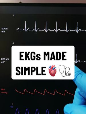 A post by @beautifulnursing on TikTok caption: EKG RHYTHMS EXPLAINED 🫀 #ekg #ecg #heartrhythms #nclex #fyp #foryou #medical #nursingschool #viral #nurse #nursingschool 