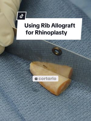 A post by @careagaplasticsurgery on TikTok caption: rhinoplasty using rib allograft 👃 #fyp #rhinoplasty #plasticsurgery 