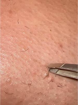 A post by @nakedskinbybrina on TikTok caption: Ingrown removal #ingrown #satisfying #skincare #fyp #waxing