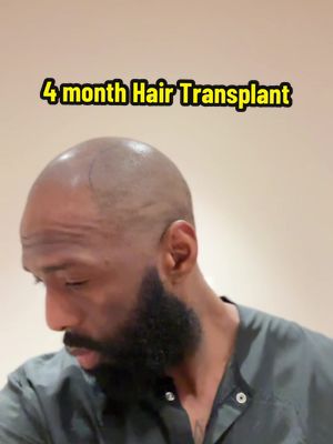 A post by @c0ryhg on TikTok caption: My 4 Month Hair Transplant update #hairtransplant #Turkey 