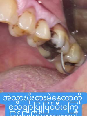 A post by @pearldentalclinic0 on TikTok caption: အံသွားပိုးစားနေတာကိုကြွေဖြင့်ပြုပြင်ထားခြင်း#ပုလဲသွားဆေးခန်း #သွားဆေးခန်း 